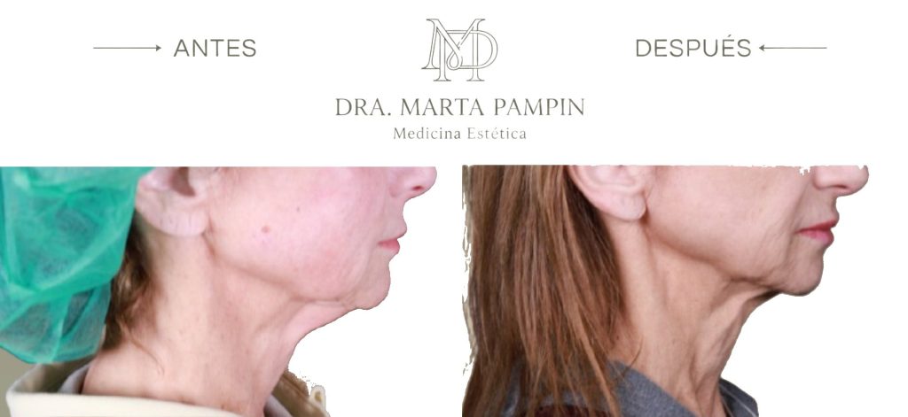 Antes y después, Dra. Marta Pampín