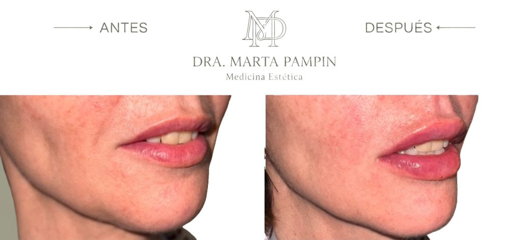 Antes y después, Dra. Marta Pampín