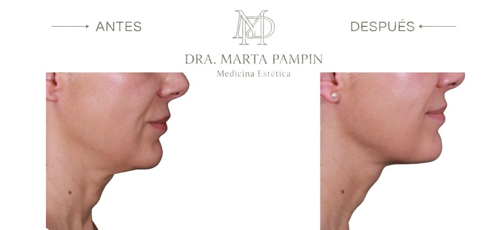 Antes y después, Dra. Marta Pampín